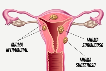 mioma miomatose menstruacao